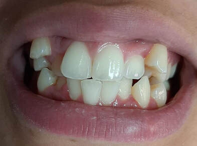 Extractions crowns and permanent bridges